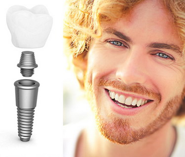 Kas yra dantų implantai